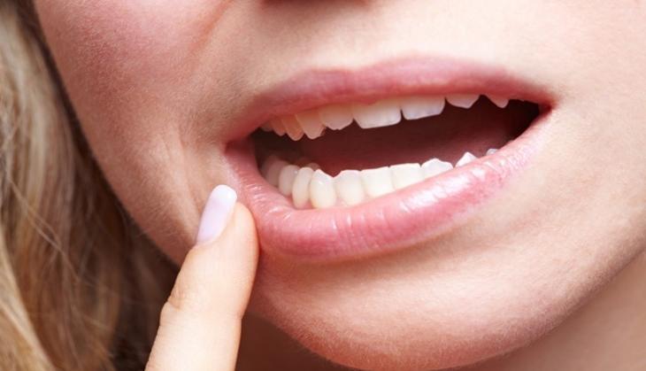 Mouth ulcers