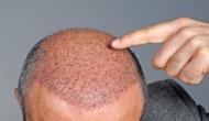 Mumbai: Shocking! Businessman dies 50 hours after hair transplant; doctors say, ‘strong allergic reaction behind death'