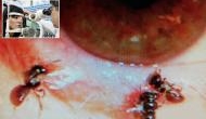 Creepy! Doctors find 4 alive bees inside woman's eye; here's the world's first weird case video