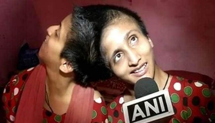 Conjoined twins
