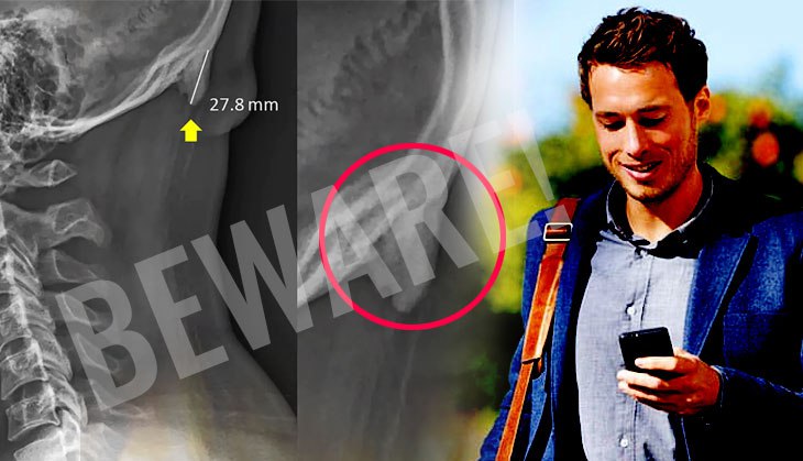 Side-effects of cellphone: Horns like 'spike' growing on young people’s skulls