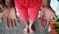 Madhya Pradesh: This family members have 12 fingers in hand and feet
