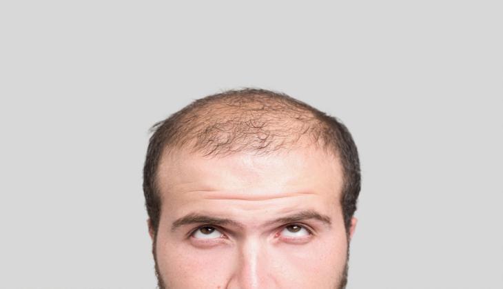 bald