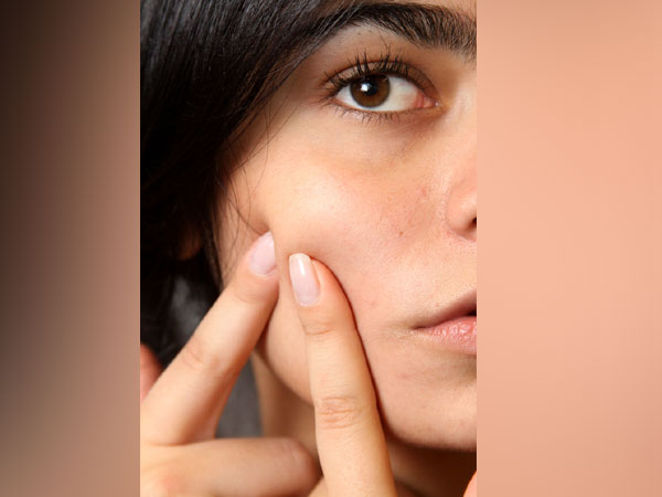 Daily consumption of sweets and cakes can cause acne!