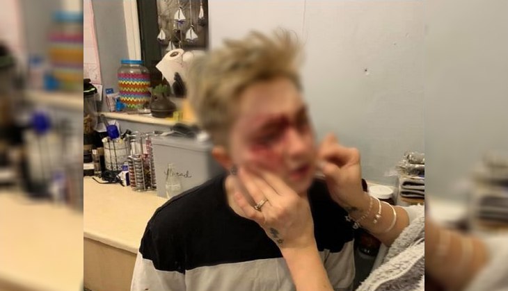 20-year-old Lesbian brutally attacked by men, shared appalling pictures