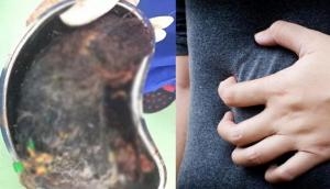 Doctor removes half kg hair, shampoo packets from girl’s stomach; picture will give you goosebumps!