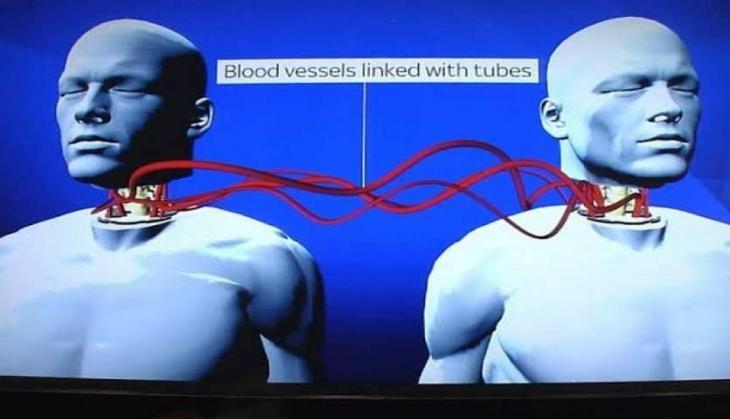 head transplant