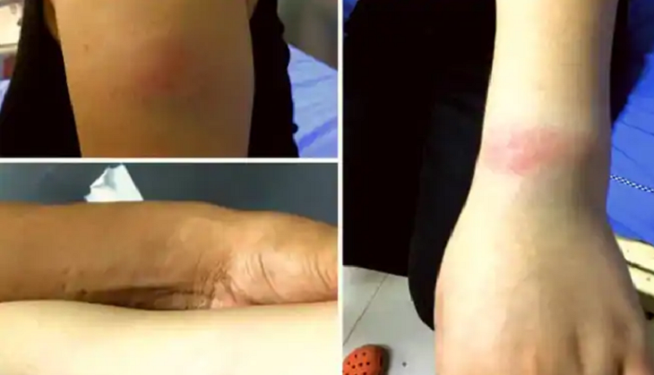 Gurugram Shocker: 20-year-old Northeast girl brutally attacked, assaulted by locals, called her ‘corona’