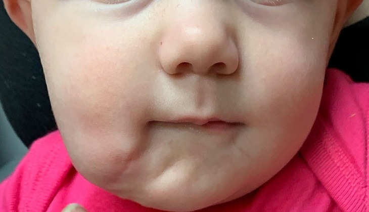 OMG! Baby born with two mouths; know what doctors do next!
