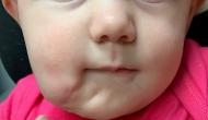 OMG! Baby born with two mouths; know what doctors do next!