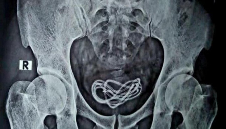 Bizarre! Doctor finds mobile charger cord inside man’s urinary bladder; know what happens next