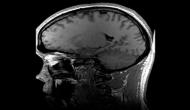 Study: Hospitalised COVID-19 patients have low risk of stroke 