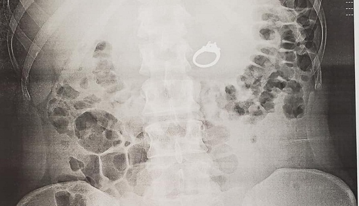 OMG! Woman eats her diamond engagement ring while sleeping; know bizarre reason