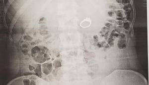 OMG! Woman eats her diamond engagement ring while sleeping; know bizarre reason