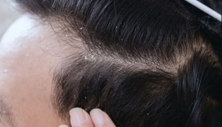 dandruff