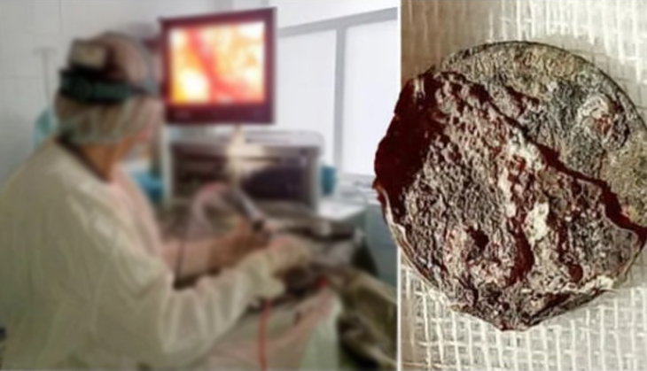 Bizarre! Man lived for over 50 years with a coin stucked in his nose; here’s what happened next