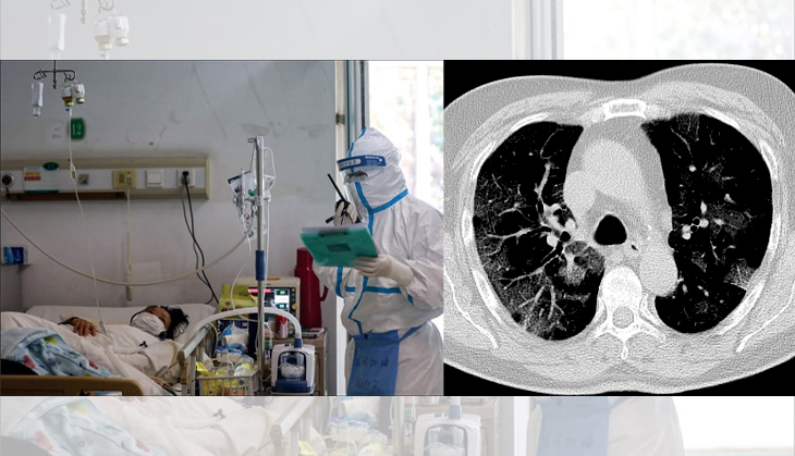 CT scan test can lead to cancer? Here's what COVID positive patient should know