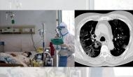 CT scan test can lead to cancer? Here's what COVID positive patient should know