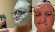 Man applies hair removal cream all over his face; know what happens next