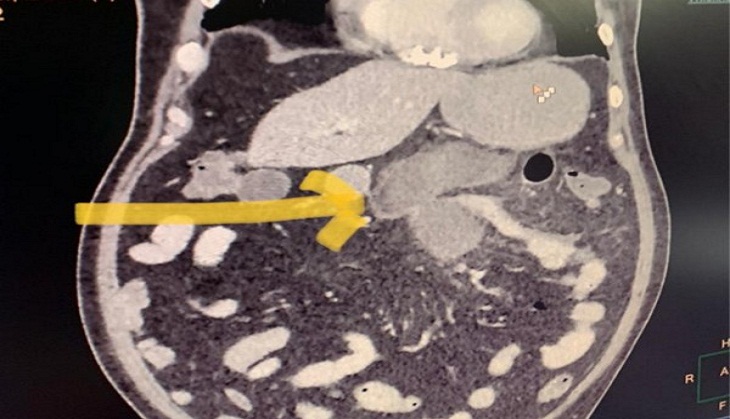 Coronavirus Pandemic: Delhi hospital reports black fungus of small intestine