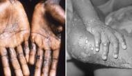US records first case of monkeypox; know the symptoms of this rare disease