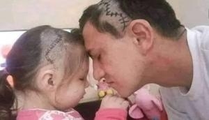 Man shaves head after daughter’s brain surgery; pic will melt your heart