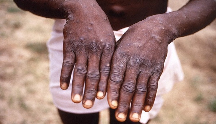 Monkeypox Outbreak: Massachusetts public health officials confirm case of monkeypox