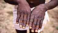 Monkeypox Outbreak: Massachusetts public health officials confirm case of monkeypox