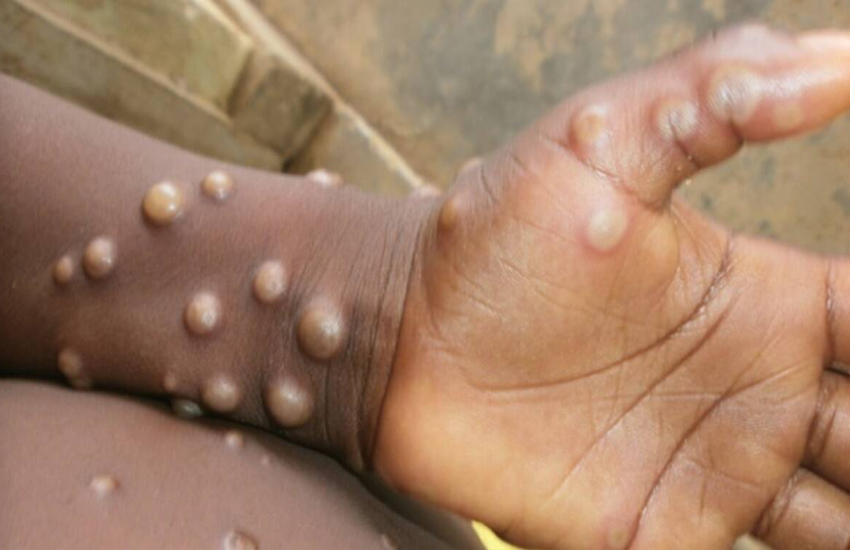 Union Govt releases guidelines for battling Monkeypox outbreak 