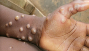 Union Govt releases guidelines for battling Monkeypox outbreak 