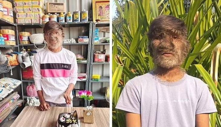 Madhya Pradesh teen with rare 'Werewolf Syndrome' shares his harrowing experience