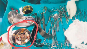 Karnataka: Doctors remove 187 coins from man’s stomach