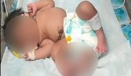 Gwalior: Girl born with 'four' legs