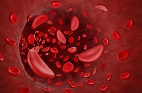 Union Budget 2023: What is sickle cell anaemia? Know all about this blood disorder