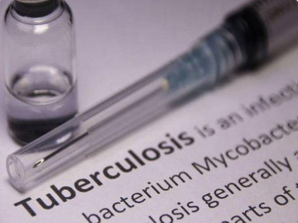 India develops mathematical model for estimation of TB burden cases, first country to do so