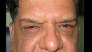 Viral Eye Flu Spreads in Kota, Doctors Warn of Community Spread