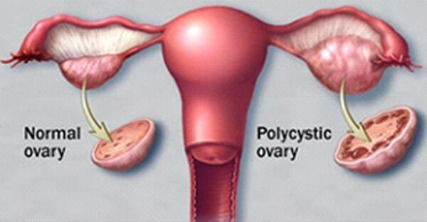 PCOS- File photo