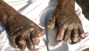 World Leprosy Day: Watch Majboor - The Feeble, a short film sensitizing people in Bollywood way 