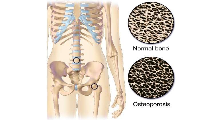 On International Osteoporosis Day, learn how to deal with the 'silent killer' 
