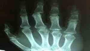 joint pain