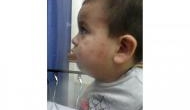 A family in California gets $1.6 million for horrible bed bugs that bite their three-year-old son 