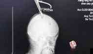 OMG! Woman with two scissors stuck in her head takes bus to reach hospital; see picture