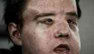 Face Off-2: French man undergoes second face transplant in medical history's first such case 