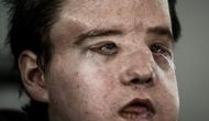 Face Off-2: French man undergoes second face transplant in medical history's first such case 