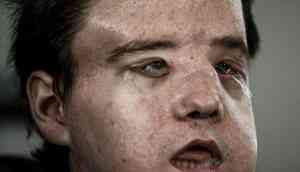 Face Off-2: French man undergoes second face transplant in medical history's first such case 