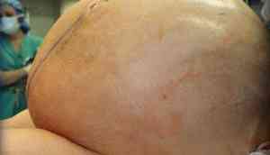 60 kg ovarian tumour removed from US woman