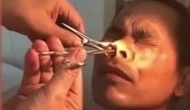 Horrifying Video: Blood-sucking leech extracted from man's nose