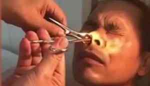 Horrifying Video: Blood-sucking leech extracted from man's nose