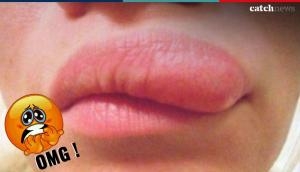 OMG! You will find a crawling parasitic roundworm in this woman's face that will give you goosebumps; see scary selfies