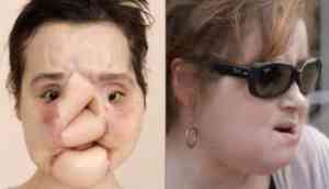 Face transplant: 21-Year-Old girl from United States gets new life after shooting herself in the face